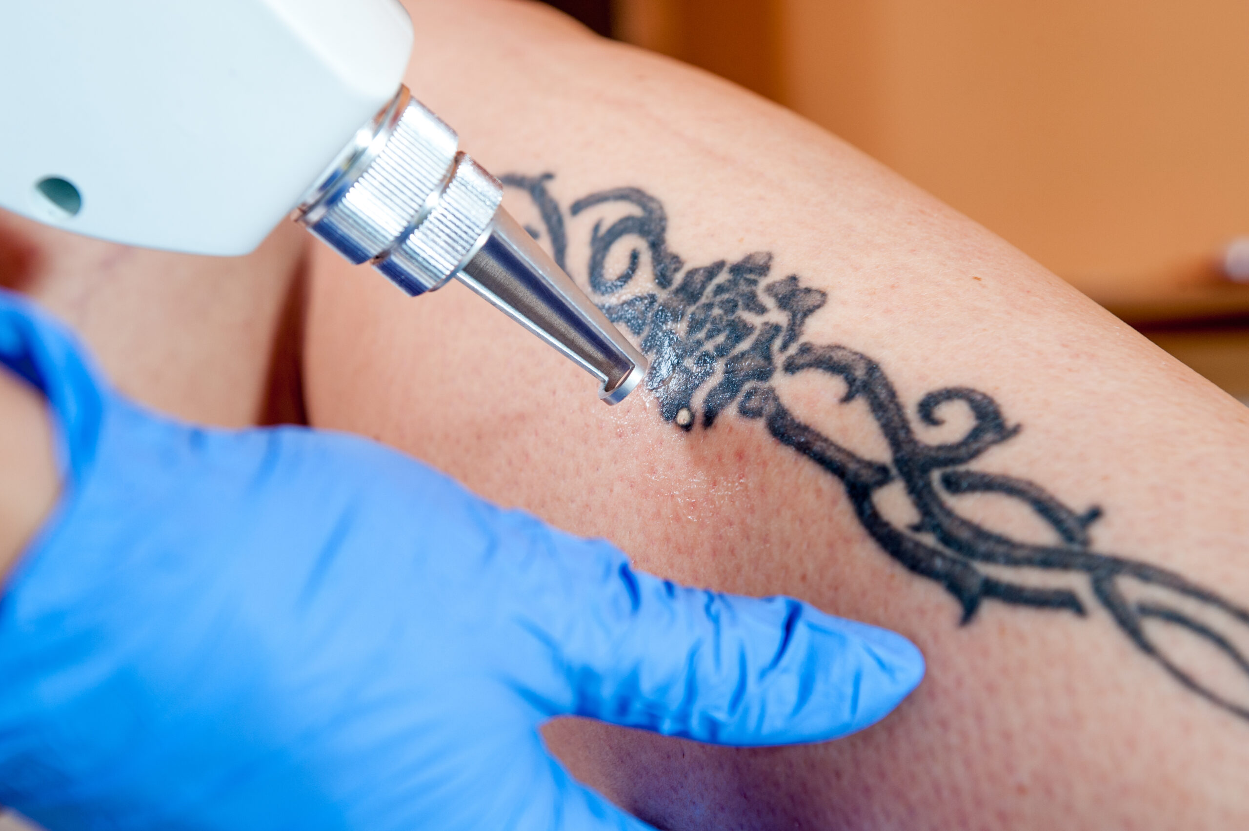 Why We Love Tattoo Removal - Results Medical Aesthetics